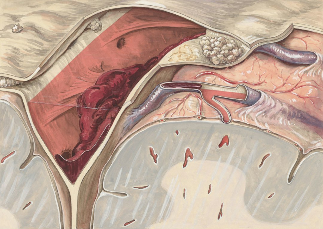 How LDL Cholesterol Builds Up in Arteries (And Why It Matters)